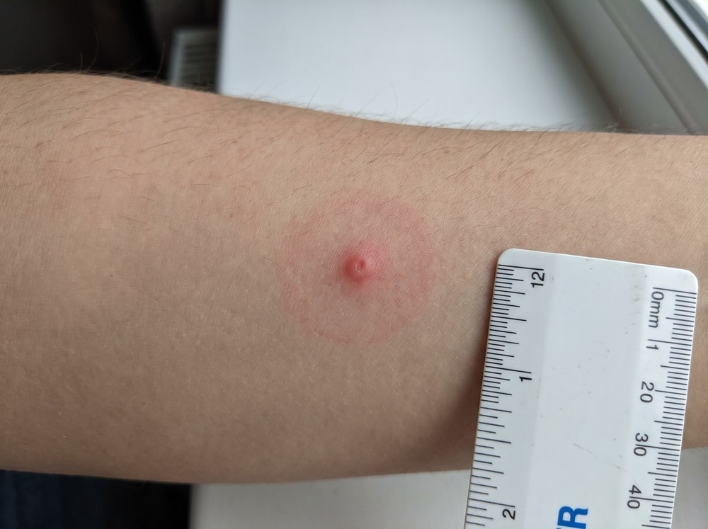 Close-up of a small red pinch-mark bite on a finger with mild surrounding redness and no visible swelling