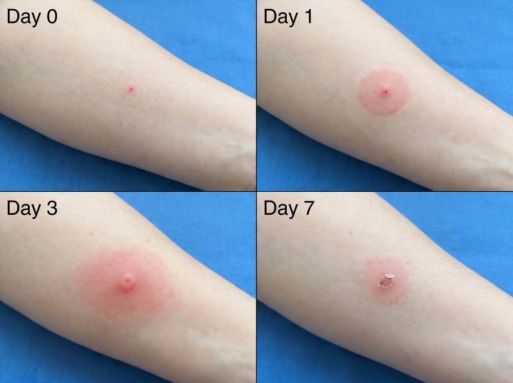 Four-panel photo series showing a Jerusalem cricket bite healing from a fresh pinch mark on Day 0 through fully resolved skin by Day 7